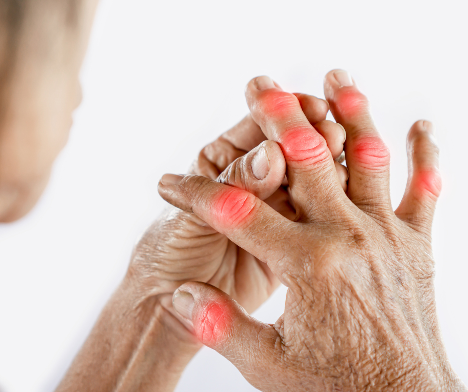 image of someone suffering with arthritis in the fingers