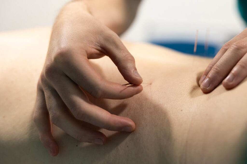 image of person receiving Acupuncture in Solihull