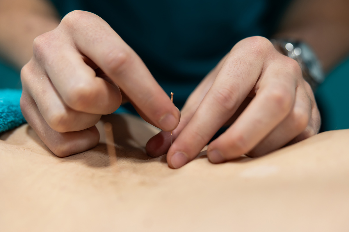 Acupuncture Holistic Treatment in Solihull, image of someone getting treatment